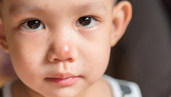 Ways To Protect Your Little Ones from Hand, Food and Mouth Disease